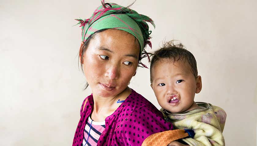 a mother carrying her child affected by cleft lip
