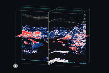 &nbsp;3D imaging of a leg ulcer shows 56% O2 saturation, with large areas of deoxygenated Hb (blue) and no Hb (black)