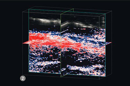 79% saturation, 20 minutes after Granulox (p=0.043), with large areas of oxygenated Hb (red and white)