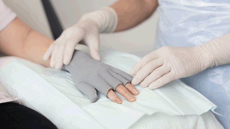 A photo of a hand with a burn dressing. 