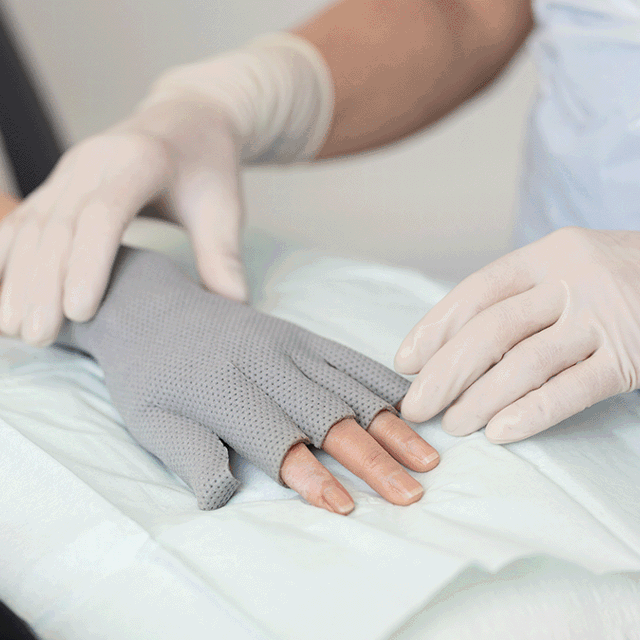 A photo of a hand with a burn dressing. 