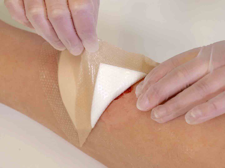 A photo of a wound dressing being peeled off an arm. 