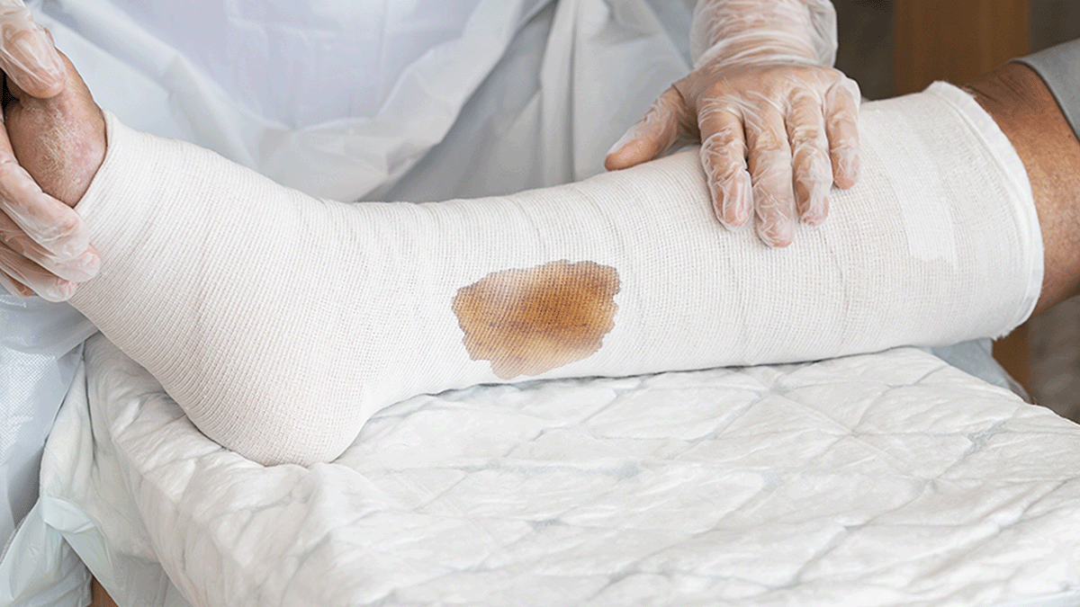 A photo of a venous leg ulcer leaking through its dressing. 