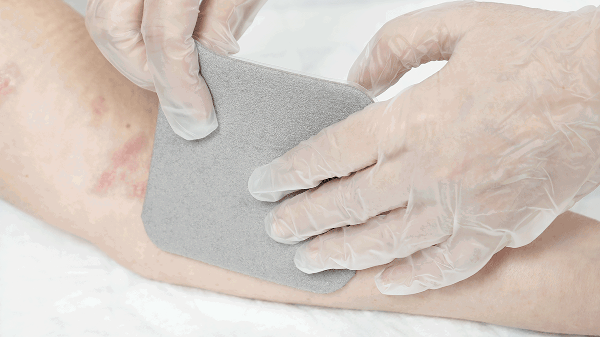 A photo of hands applying a Mepilex Ag wound dressing.