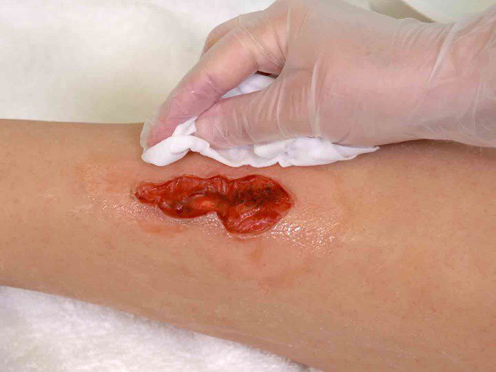 A photo of a hand cleaning the skin surrounding a wound.