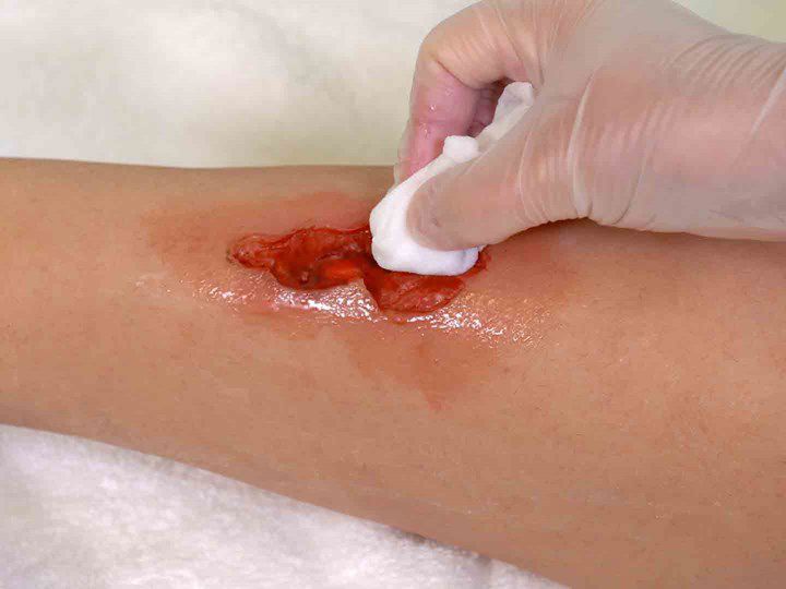 A photo of a hand using gauze to clean a wound.