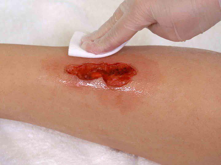 A photo of a hand using gauze to pat dry the skin surrounding a wound.