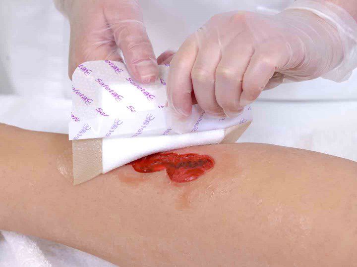 A photo of two hands applying a wound dressing to a wound.