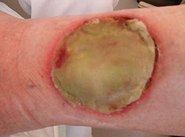 ersch&ouml;pftes Alginat