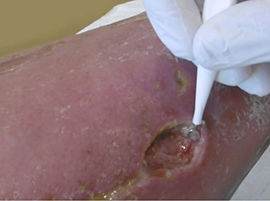 Chirurgisches D&eacute;bridement mit einer Ringk&uuml;rette