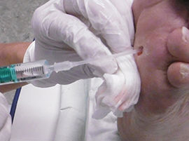 Wundsp&uuml;lung mit Knopfkan&uuml;le