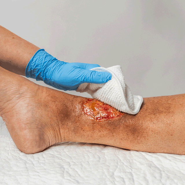 A photo of a hand using a Mepi Debripad on a leg ulcer.