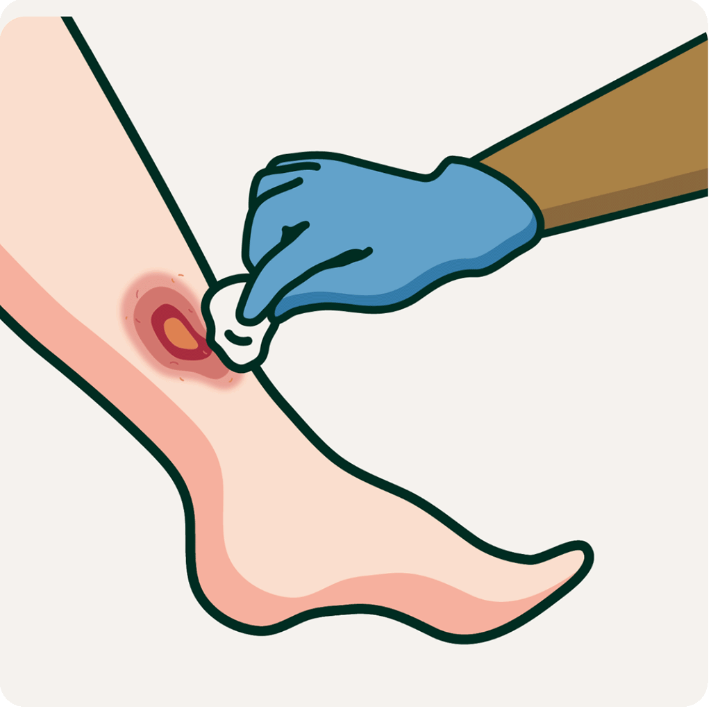 A hand cleaning a leg ulcer. Illustration. 