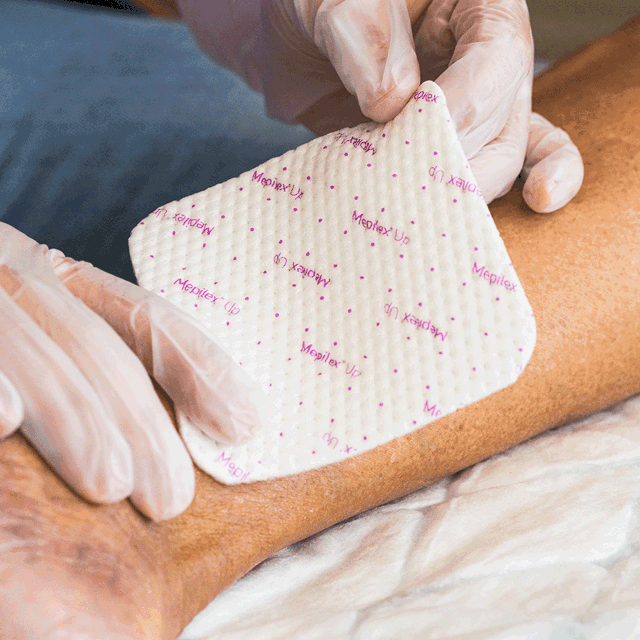 A photo of hands applying a Mepilex Up dressing on a leg ulcer.