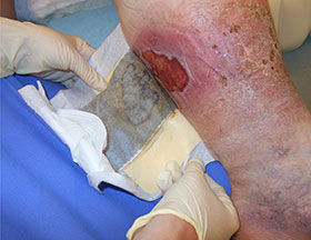 Abb.7: alten Verband mit unsterilen Einmalhandschuhen entfernen