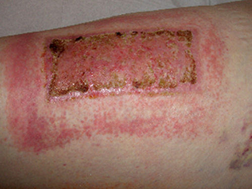 Abb. 2: Unvertr&auml;glichkeit auf Wundauflage