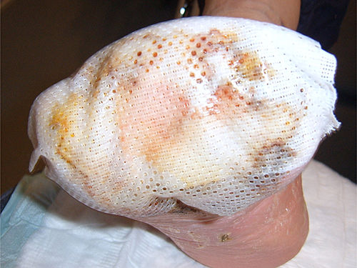 Abb. 3: falsche Applikation