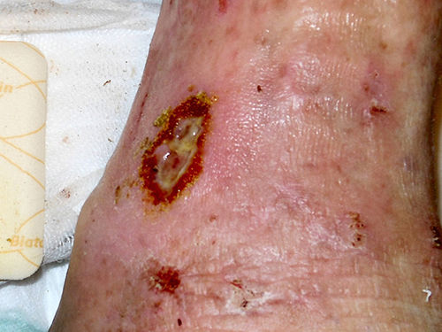 Abb. 4: Wundauflage falsch herum appliziert