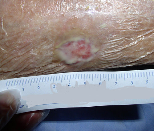 vor der Wundreinigung