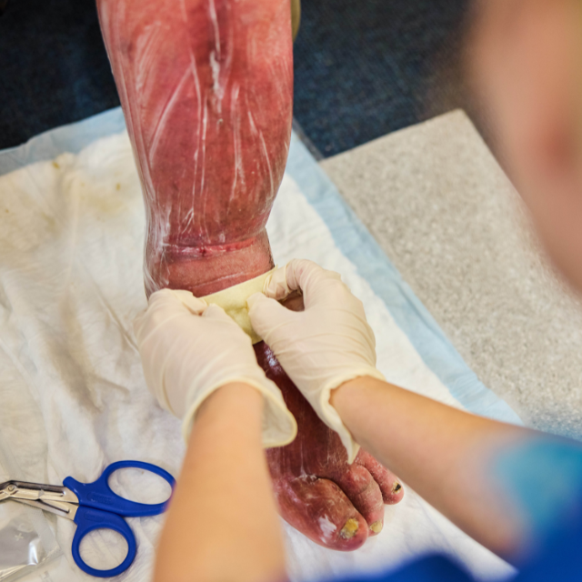 Venous leg ulcer with emollient and Exufiber