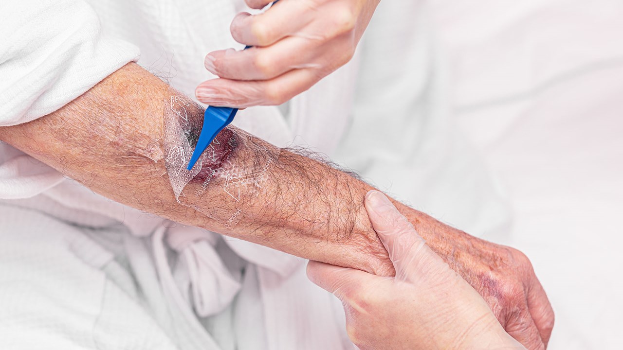 nurse removing a dressing from arm with a wound